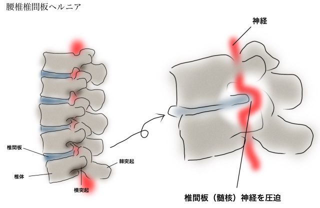 腰椎椎間板ヘルニアの解説図